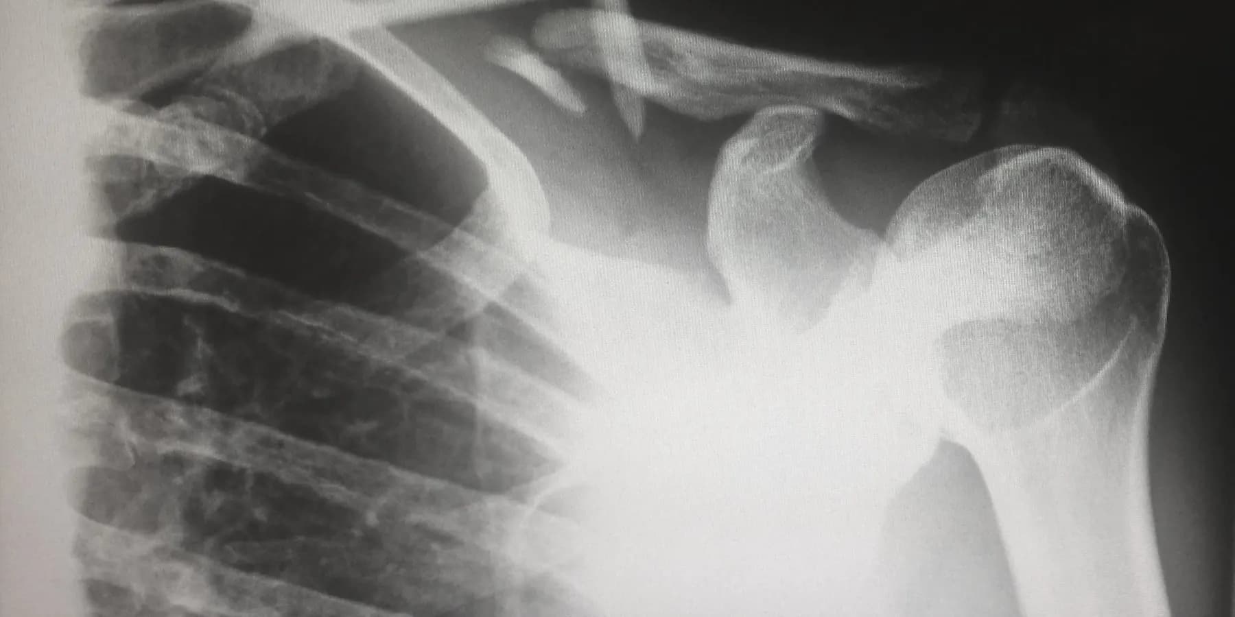 A plain radiograph of a shoulder on a viewing screen.