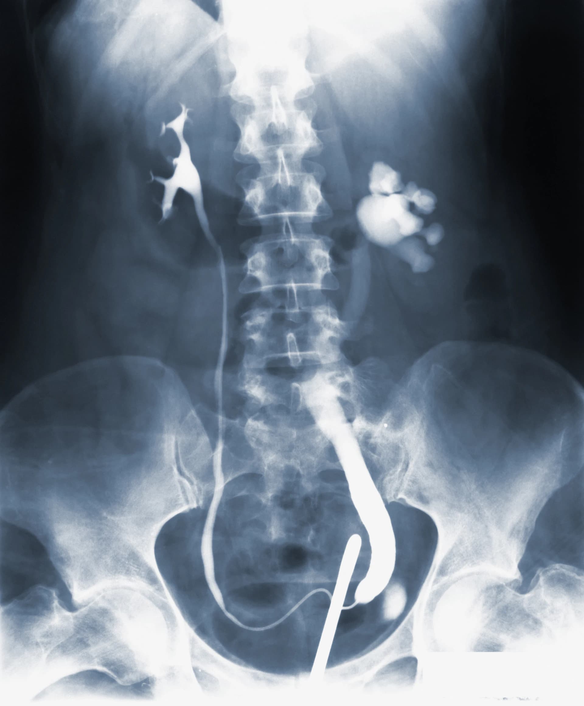 A spinal radiograph on a viewing panel.