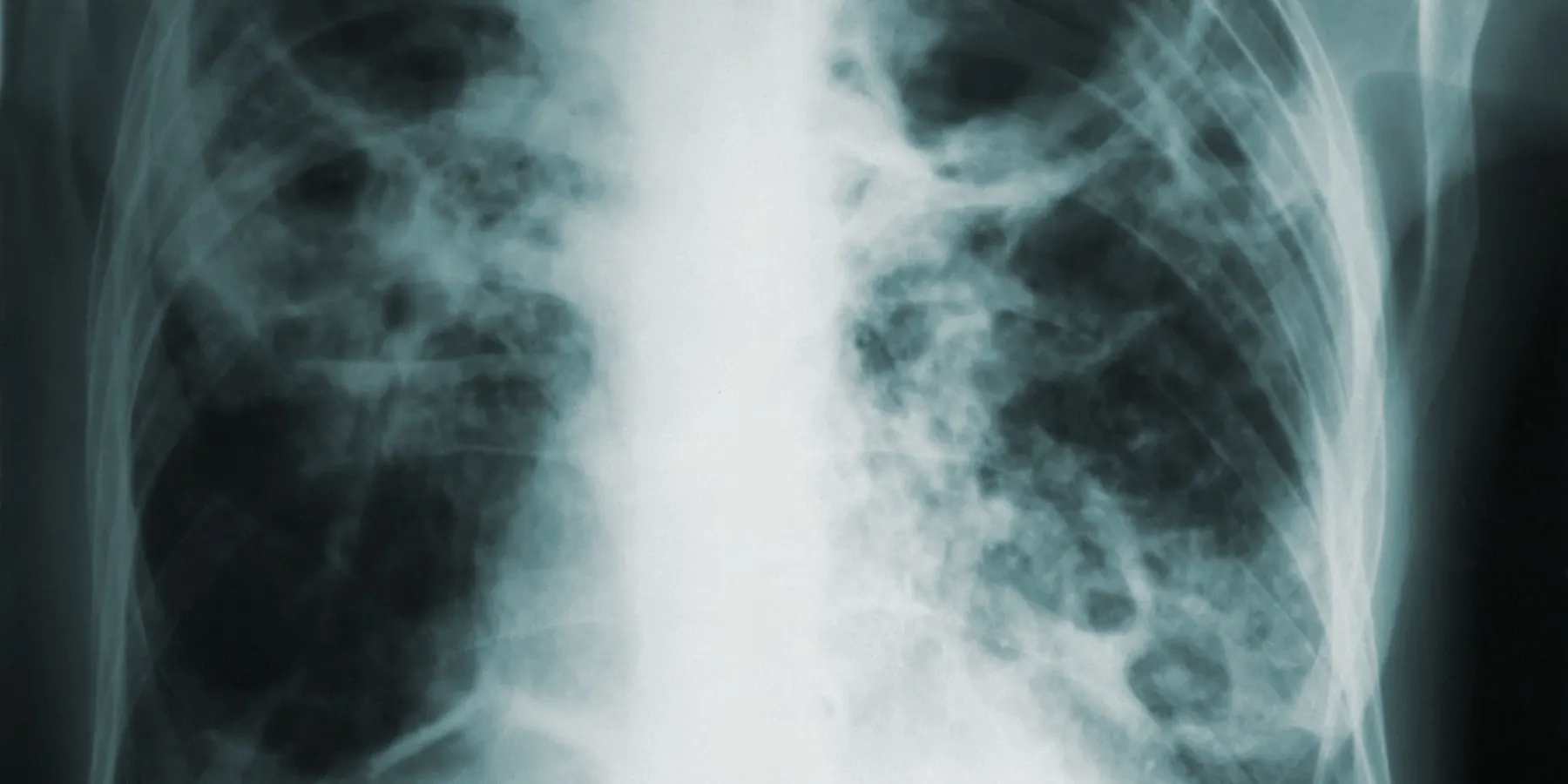 A plain chest radiograph on a viewing screen.